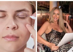 Ce este Blefaroplastia — intervenția estetică în vogă pentru ochi mai odihniți